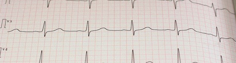EKG
