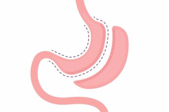 magen-ops_adobestock_509578814_schlauchmagen_qf.jpg