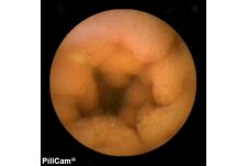 pillcam_videokapsel_endoskopiebild_klinik_bogen.jpg