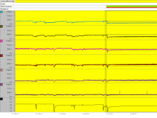 pH-Metrie Innere Medizin