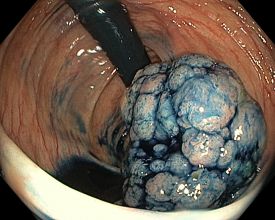 Coloskopie Innere Medizin