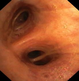 Bronchoskopie Innere Medizin