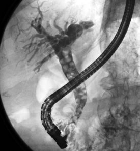 Gallensteine Innere Medizin