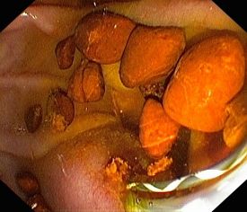 Gallengangsteine Innere Medizin