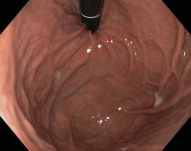 Gastroskopie Innere Medizin