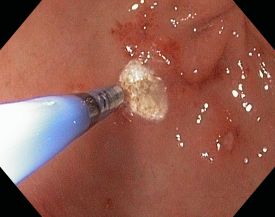 Argon-Beamer Innere Medizin