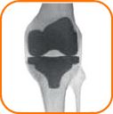 Knie-TEP Unfallchirurgie