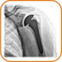 Schulterprothese Unfallchirurgie