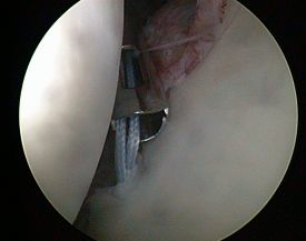 Schulterarthroskopie Unfallchirurgie