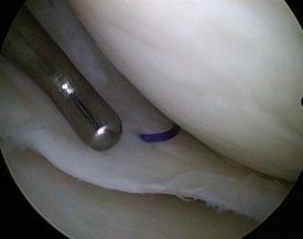 Kniegelenkarthroskopie Unfallchirurgie