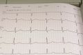 EKG & Kardiologische Tests