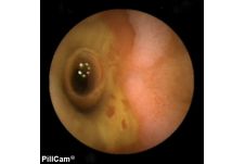 Videokapsel-Endoskopie pillcam_videokapsel_endoskopiebild_stenose_klinik_bogen.jpg