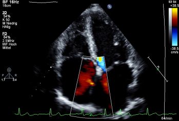 Herzecho-Untersuchungsbild Innere Medizin