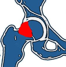 Cam-Impingement am Hüftgelenk Unfallchirurgie