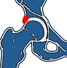 Pincer-Impingement Unfallchirurgie